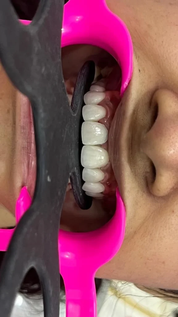 Close-up of newly restored front teeth during a cosmetic dental visit