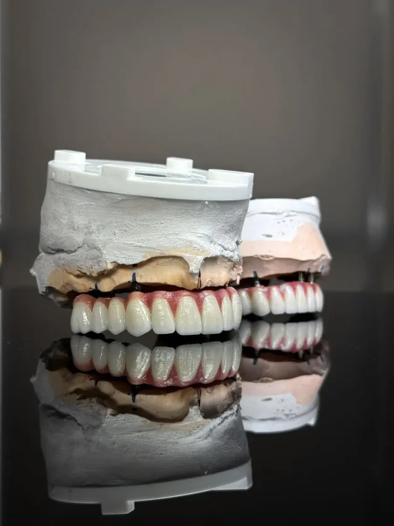 Models of dental bridges used to explain tooth replacement