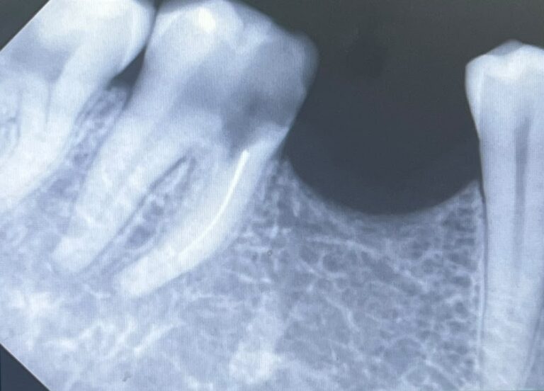 Anonymised dental X-ray showing a root canal treated molar at The Smile Makers Dental Clinic, Khar West, Mumbai