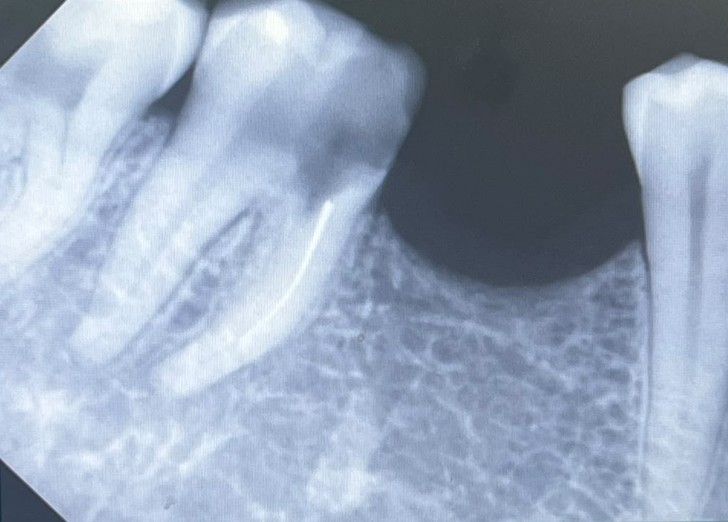 Anonymised dental X-ray showing a root canal treated molar at The Smile Makers Dental Clinic, Khar West, Mumbai