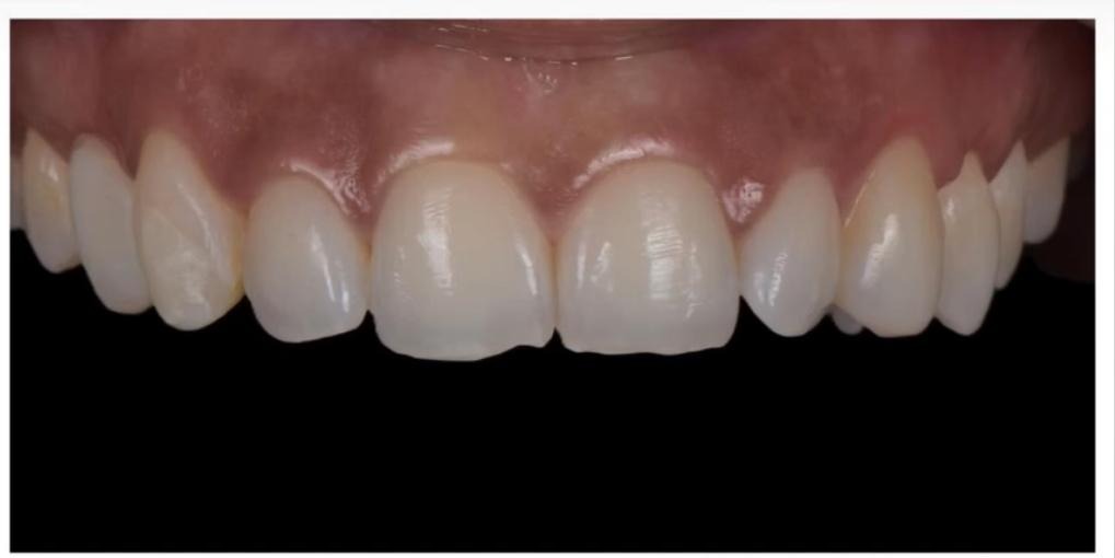 Teeth whitening before treatment at The Smile Makers Dental Clinic, Khar West