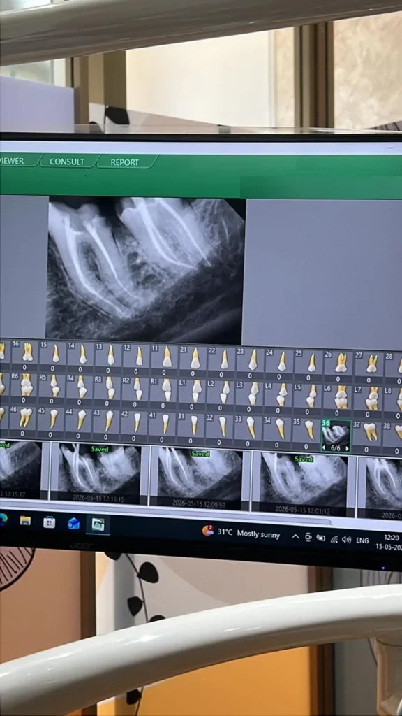 Digital dental X-ray of a root canal treated molar on the clinic monitor
