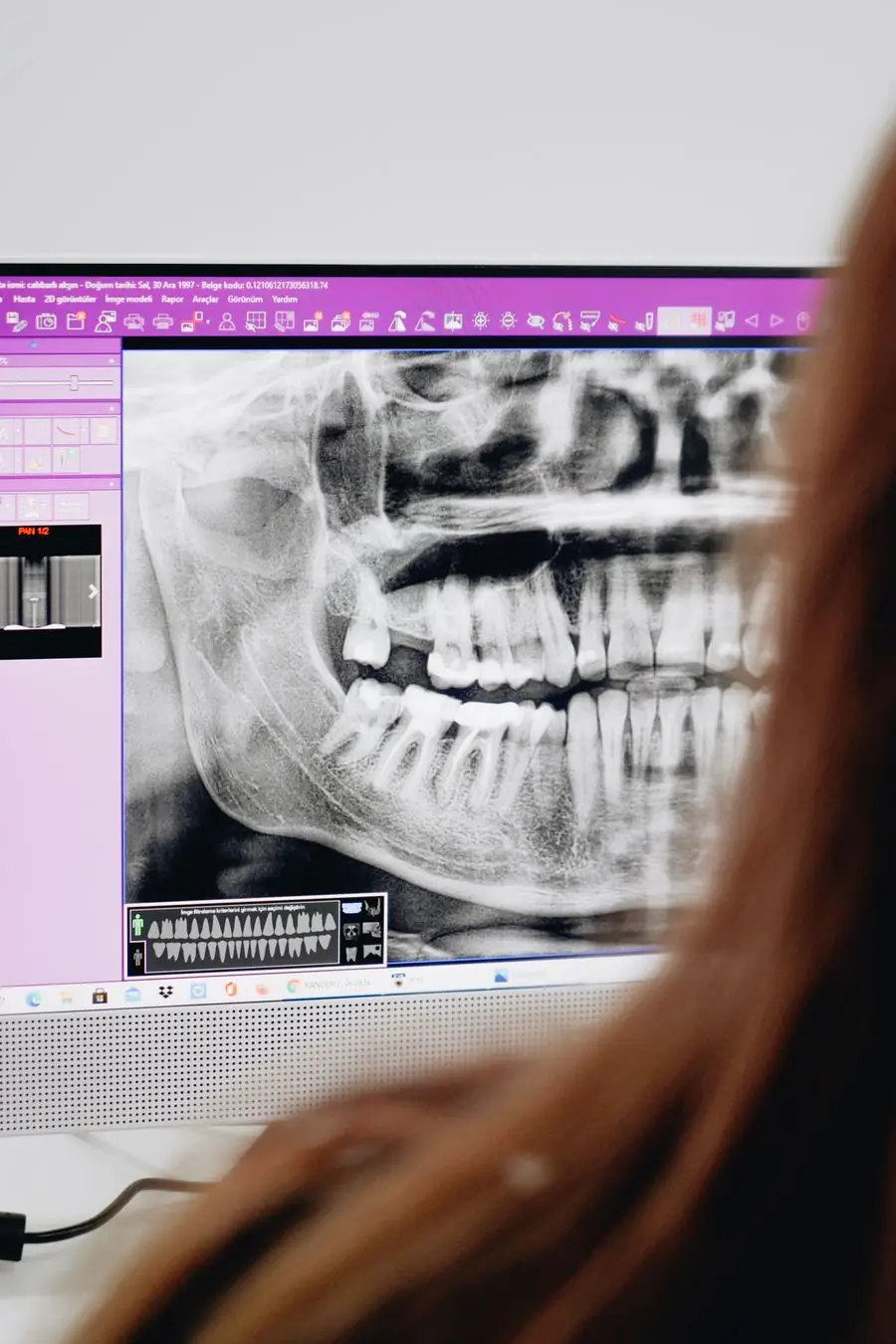 Panoramic dental X-ray showing wisdom teeth