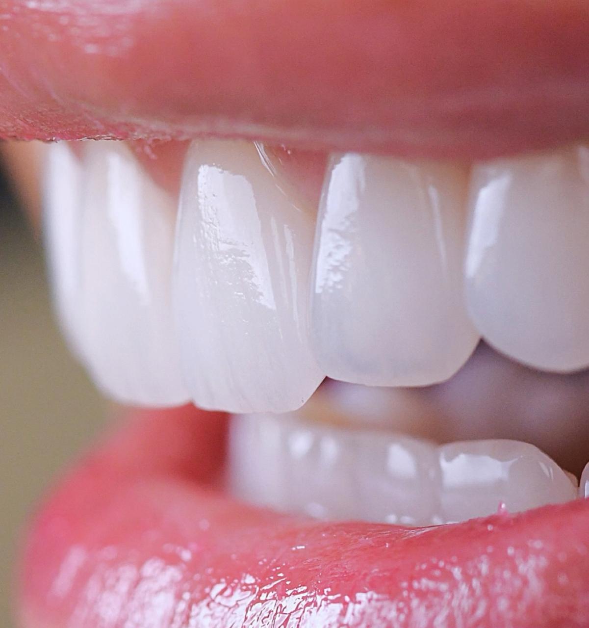 Close-up of front teeth after smile makeover at The Smile Makers Dental Clinic, Khar West