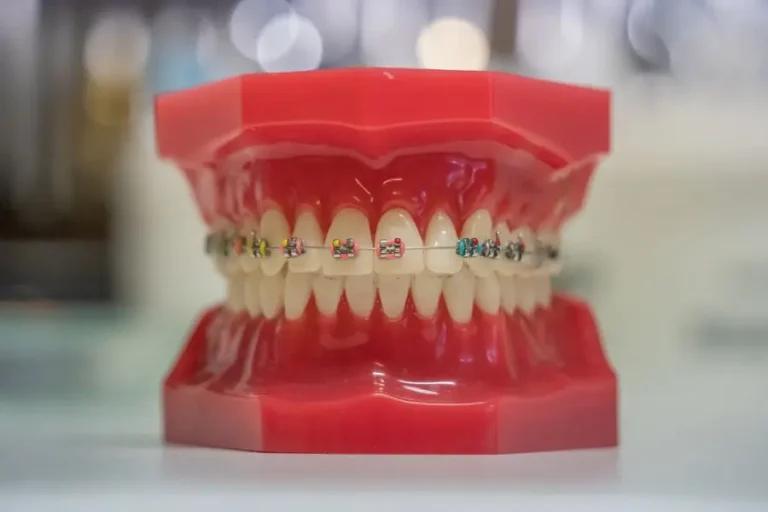 Orthodontic braces model showing brackets and wire
