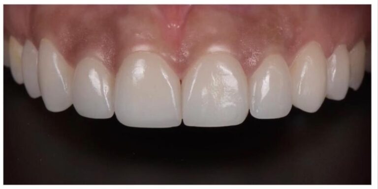 Teeth whitening after treatment at The Smile Makers Dental Clinic, Khar West