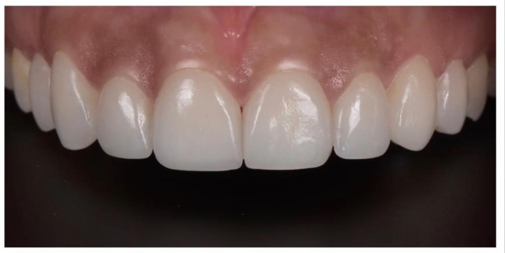 Teeth whitening after treatment at The Smile Makers Dental Clinic, Khar West
