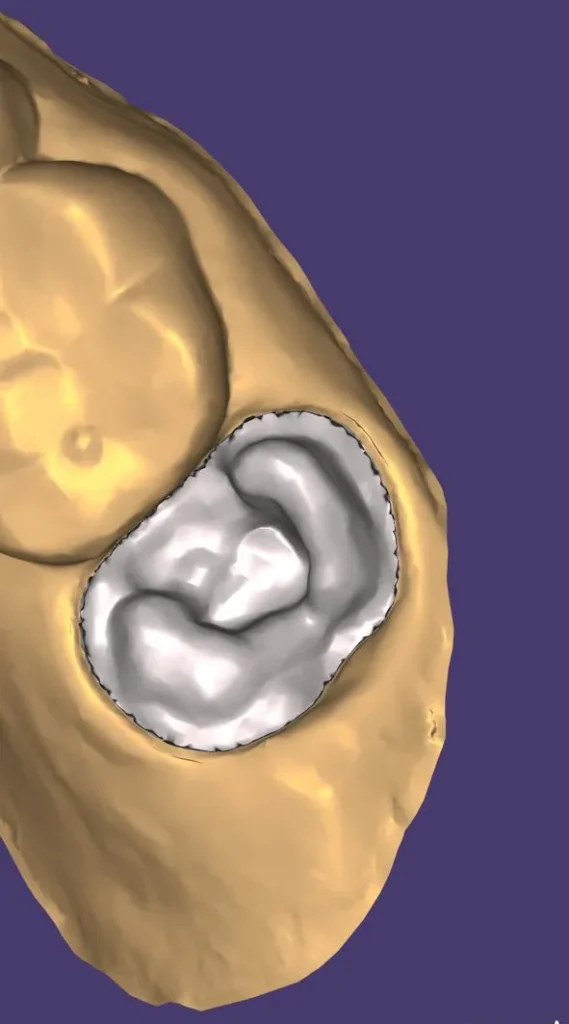 Digital crown design for a molar in exocad software