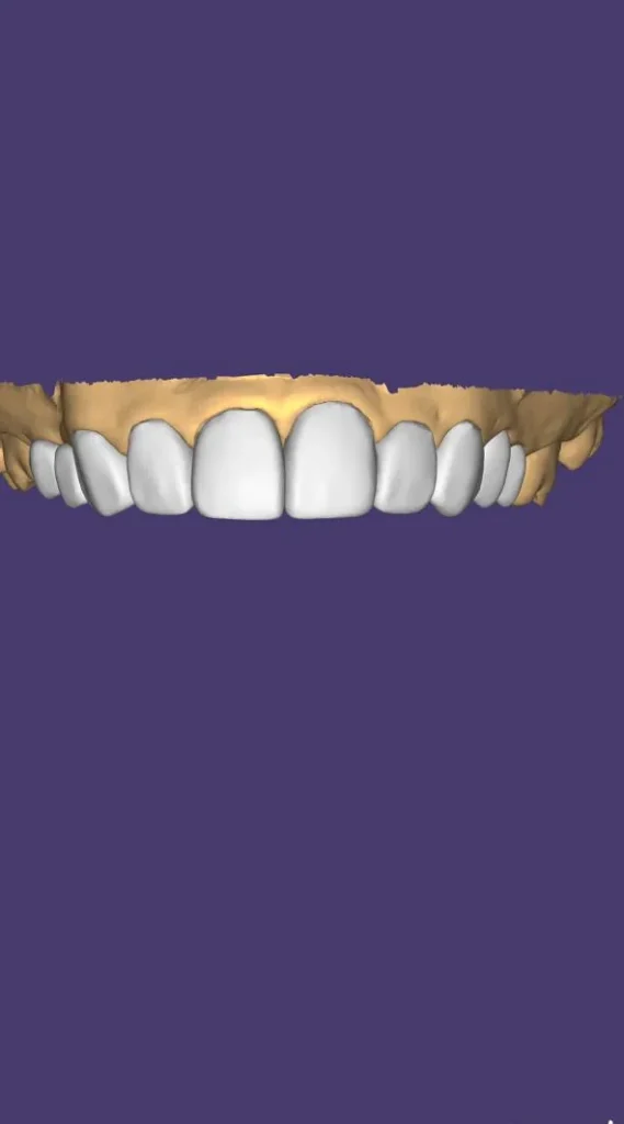 Digital smile design of front teeth in exocad software