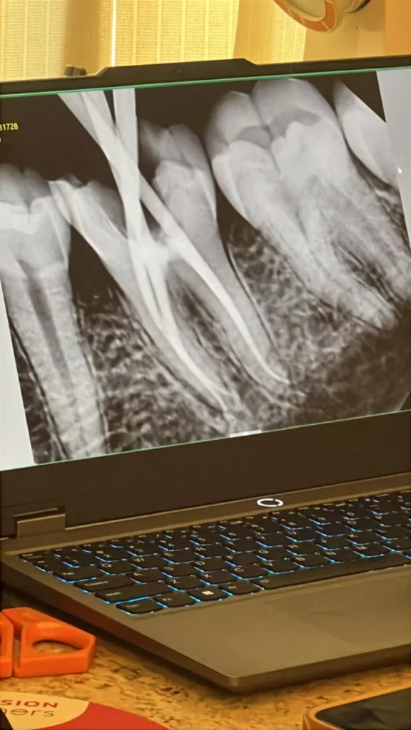 X-ray of a lower molar after root canal treatment