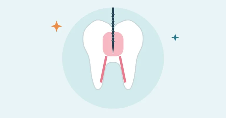 Illustration of a tooth with a root canal file inside the pulp chamber