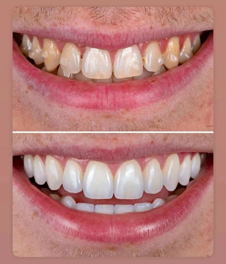 Before and after smile makeover at The Smile Makers Dental Clinic, Khar West, Mumbai