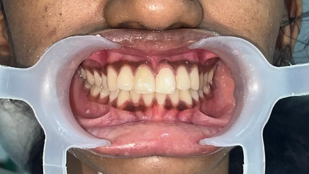 Close-up of well-aligned natural-looking teeth after dental treatment