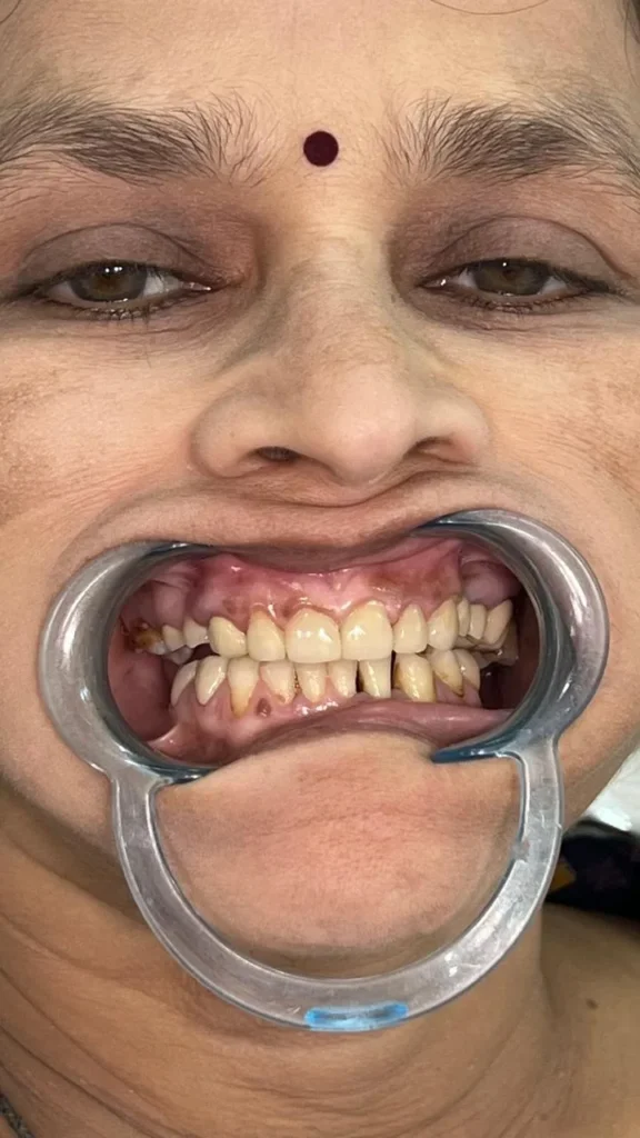 Patient dental check-up with cheek retractor before treatment
