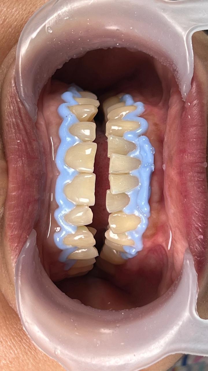In-office teeth whitening in progress at The Smile Makers Dental Clinic, Khar West