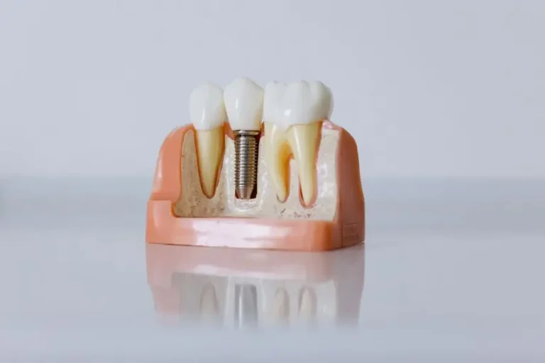 Cross-section model of a dental implant with crown