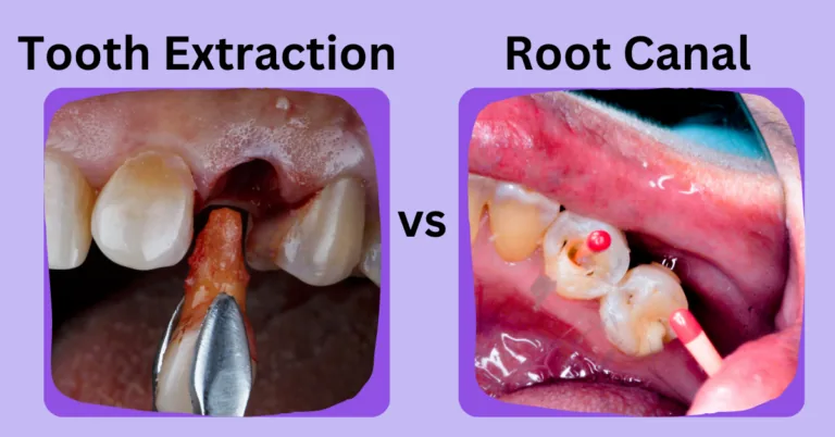 Comparison graphic of tooth extraction versus root canal