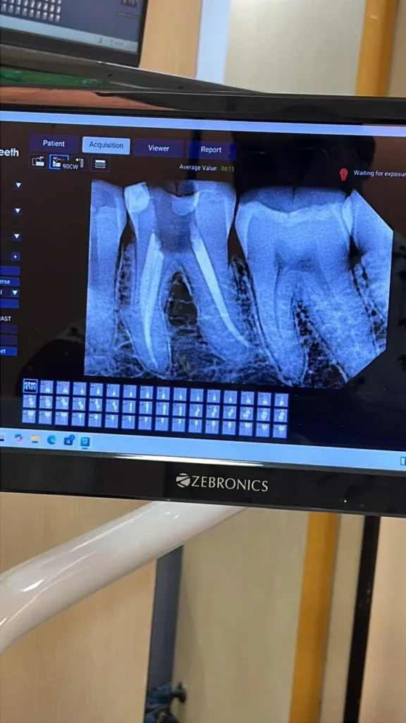 Digital X-ray of molars with root canal fillings on clinic imaging screen