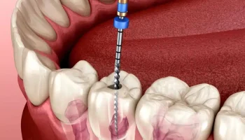 Non-Surgical-Root-Canal-Treatment