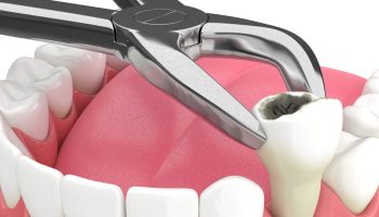 tooth-extraction-dental-service-1024x768