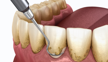 what-is-periodontal-therapy-960x540